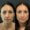 Before and after photo of a patient who underwent full facial balancing with Sculptra filler and wrinkle relaxers at Austin Aesthetic Atelier, showcasing enhanced facial symmetry and rejuvenation.